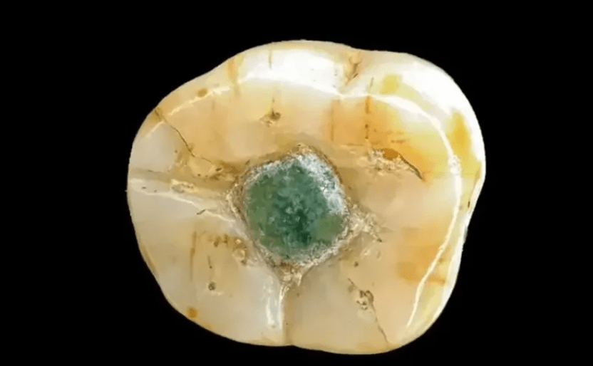 Odontología de vanguardia hace 2.500 años: los mayas y el primer «empaste» con piedras&nbsp;preciosas